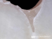 Die überlegende Adhäsivtechnologie von UltraSeal XT hydro führt zu einer herausragenden Haftung an der Zahnsubstanz
