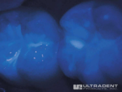 Dank seiner fluoreszierenden Eigenschaft ist UltraSeal XT hydro unter Schwarzlicht vollständig sichtbar.