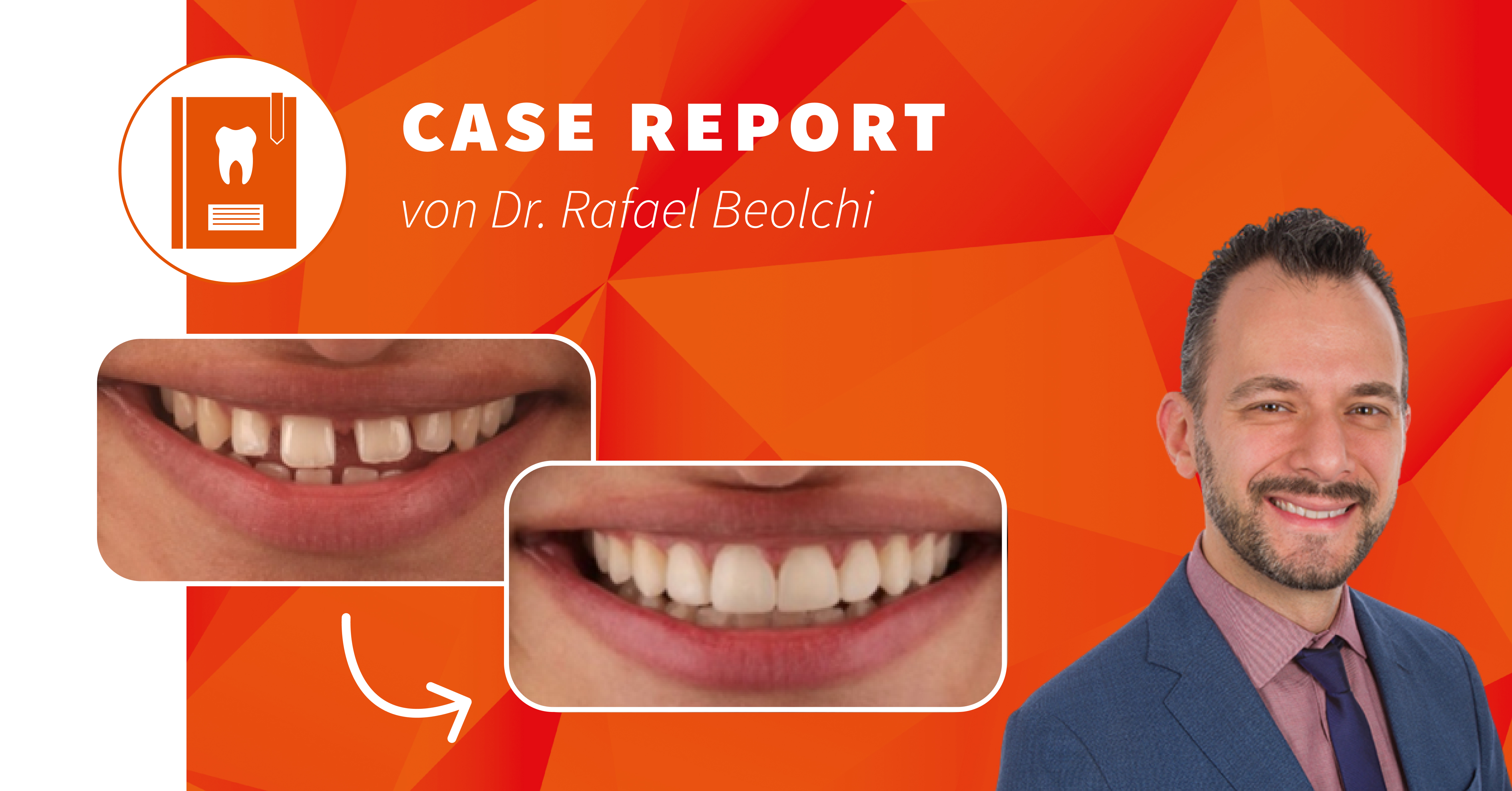 Wie Diodenlaser und Universalkomposits den Praxisalltag erleichtern
