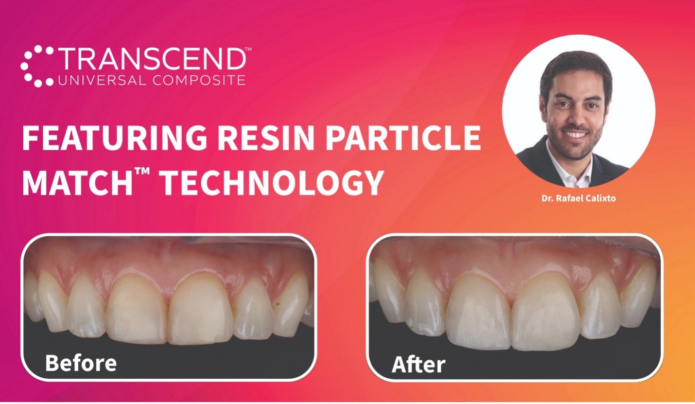 Klinischer Leitfaden: Klasse-II-Restauration der mittleren Schneidezähne im Oberkiefer